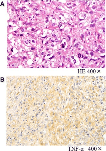 Two histology panels: H&E showing markedly pleomorphic tumour cells and a TNF-alpha immunostain