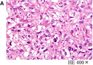 H&E histology showing sheets of markedly pleomorphic tumour cells with no osteoid.