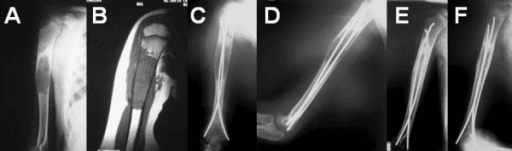 Multi-panel imaging of a proximal humeral unicameral bone cyst with pathological fracture, MRI, and elastic-nail fixation with healing.