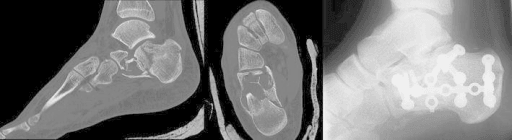 CT and post-operative radiograph of a calcaneal unicameral bone cyst with pathological fracture treated by plate fixation.