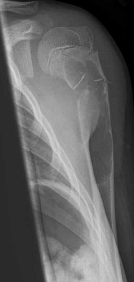 AP radiograph of a proximal humeral unicameral bone cyst with a pathological fracture and fallen fragment.
