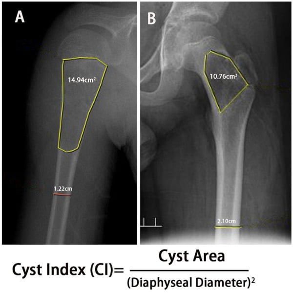 Radiographs illustrating Cyst Index calculation in proximal humerus and proximal femur