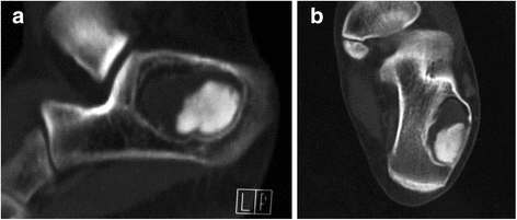 Sagittal and coronal CT images of a calcaneal unicameral bone cyst