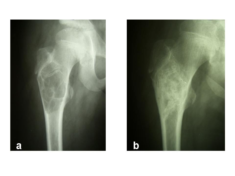 Radiographs of a proximal femur unicameral bone cyst before and after curettage and bone grafting