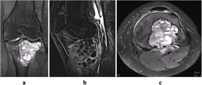 Coronal, sagittal, and axial MRI of an aneurysmal bone cyst showing fluid-fluid levels