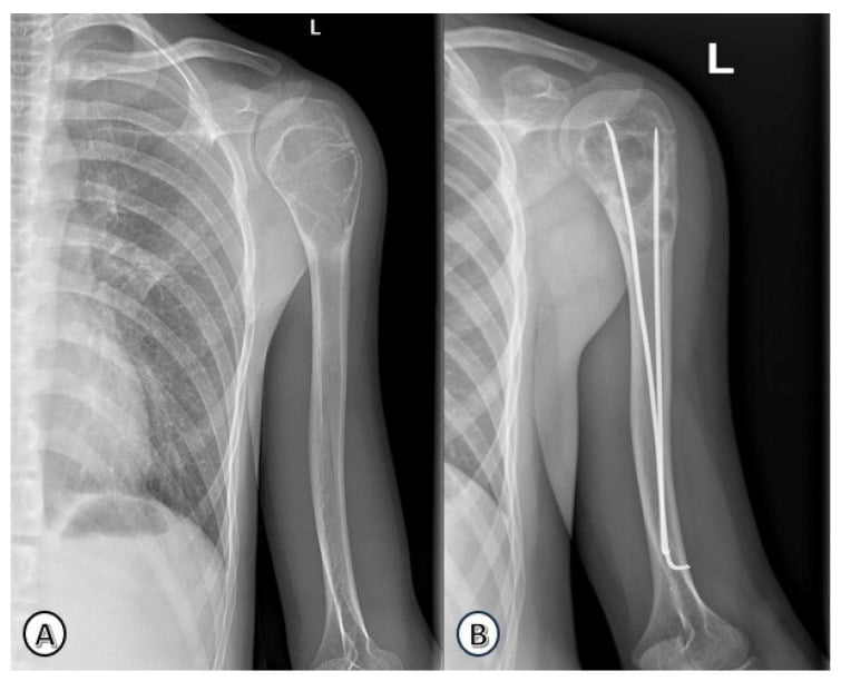 Anteroposterior radiographs showing active to latent evolution of a humeral unicameral bone cyst