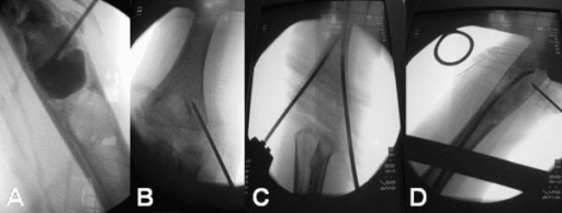 Fluoroscopic images of cystogram and K-wire drilling for unicameral bone cyst treatment