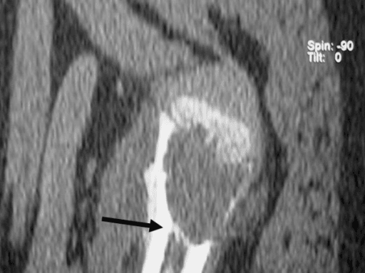 Coronal CT image showing a bony plug causing venous obstruction in a unicameral bone cyst