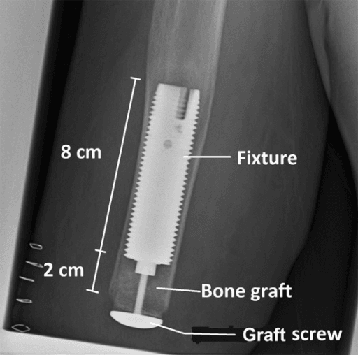 Radiograph of an osseointegrated (bone-anchored) prosthetic fixture in the medullary canal, with the countersunk distal end filled by autologous bone graft and a graft screw.