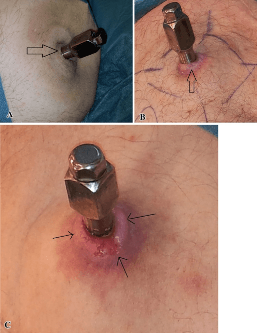 Clinical photographs of skin reactions at the skin-penetration (abutment) site of an osseointegrated prosthesis - discoloration, redness and hypertrophic granulation tissue.