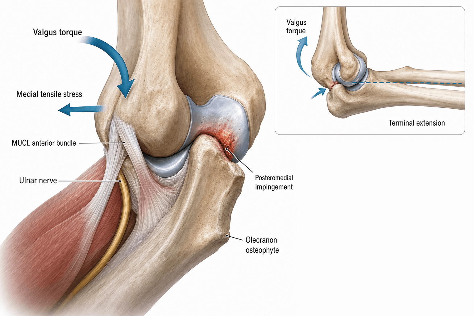 Illustration of valgus extension overload: medial elbow with valgus torque and medial tensile stress on the MUCL and ulnar nerve, posteromedial impingement and an olecranon osteophyte, with an inset showing impingement at terminal extension.