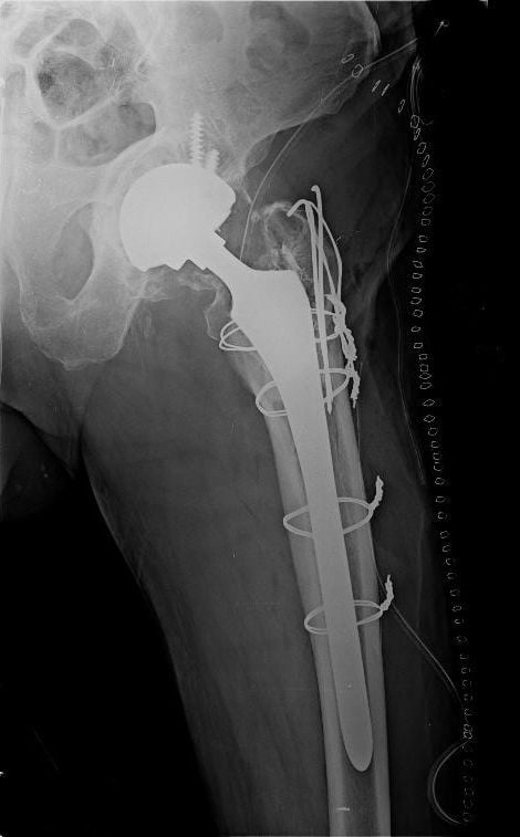 AP radiograph of the same hip after fixation of the periprosthetic fracture with cerclage cables, with the femoral stem retained.