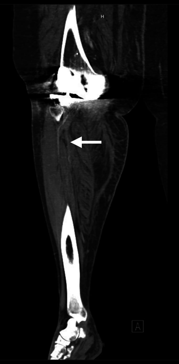 Lower-limb CT angiogram showing absent contrast in distal runoff vessels after knee injury.