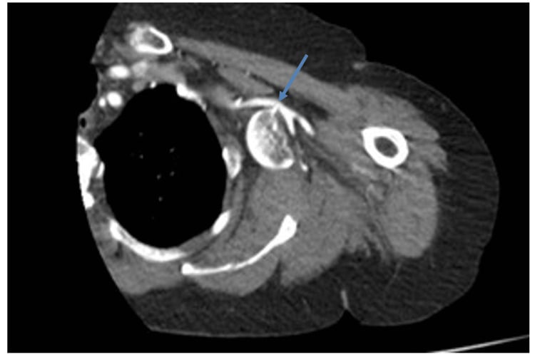 Axial CT angiogram showing a displaced humeral head contacting the axillary artery.