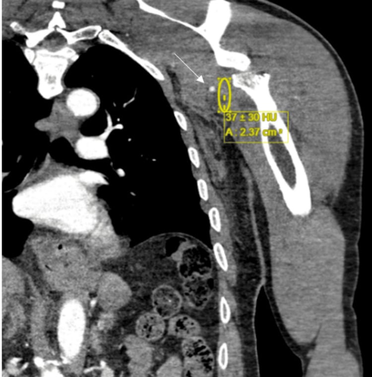 Coronal upper-limb CT angiogram showing axillary artery transection after proximal humeral trauma.