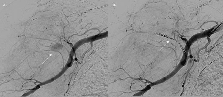 Angiograms showing an axillary artery pseudoaneurysm before and after coil embolisation.