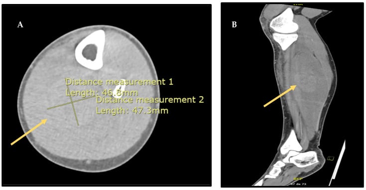 Axial and sagittal CT showing deep posterior compartment swelling and an intramuscular soleus haematoma.