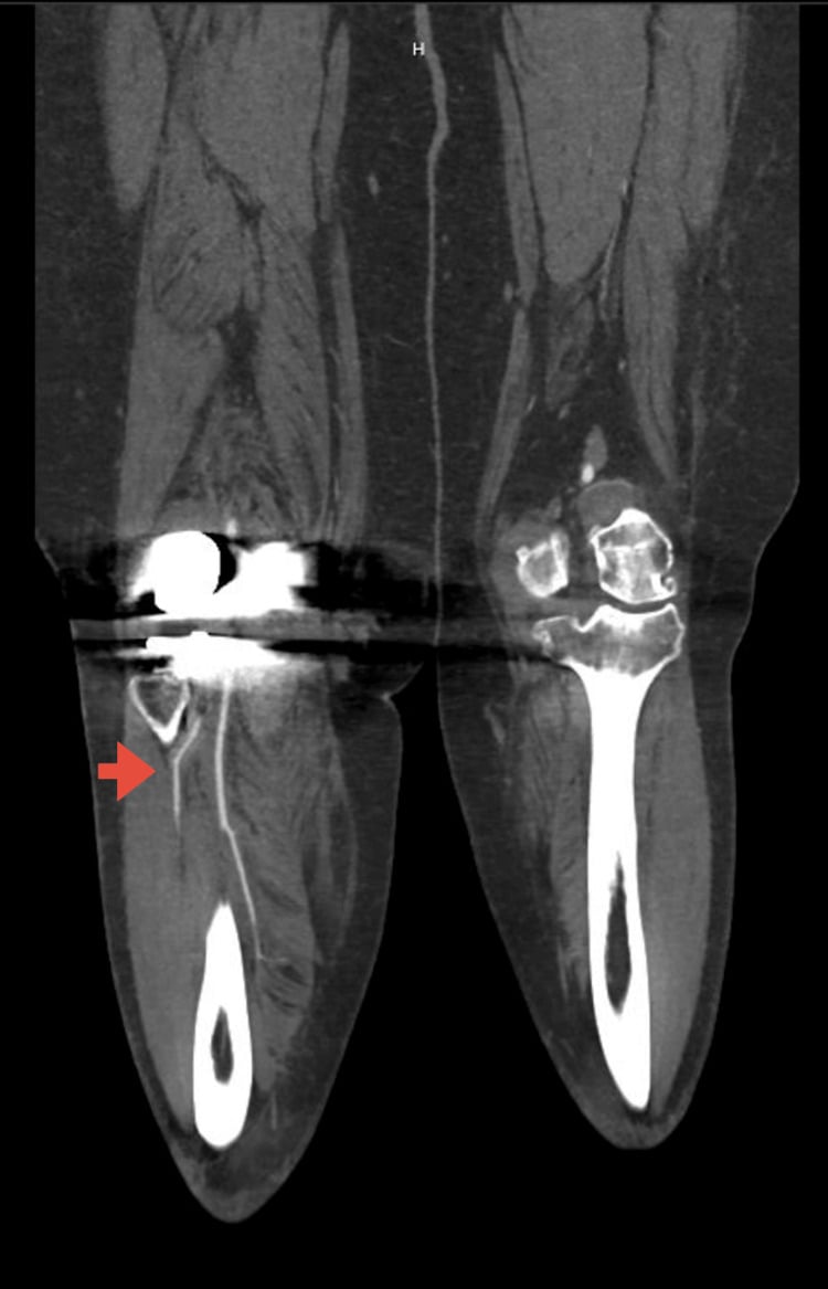 Lower-limb CT angiogram showing preserved contrast in distal runoff vessels after knee injury.