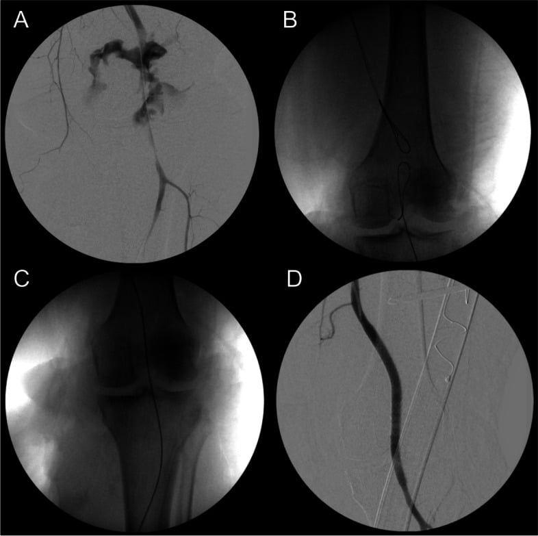 Angiographic sequence showing wire crossing and covered-stent treatment of a popliteal artery injury.