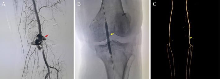 Digital subtraction angiography and CTA showing ruptured popliteal pseudoaneurysm treatment with a covered stent.
