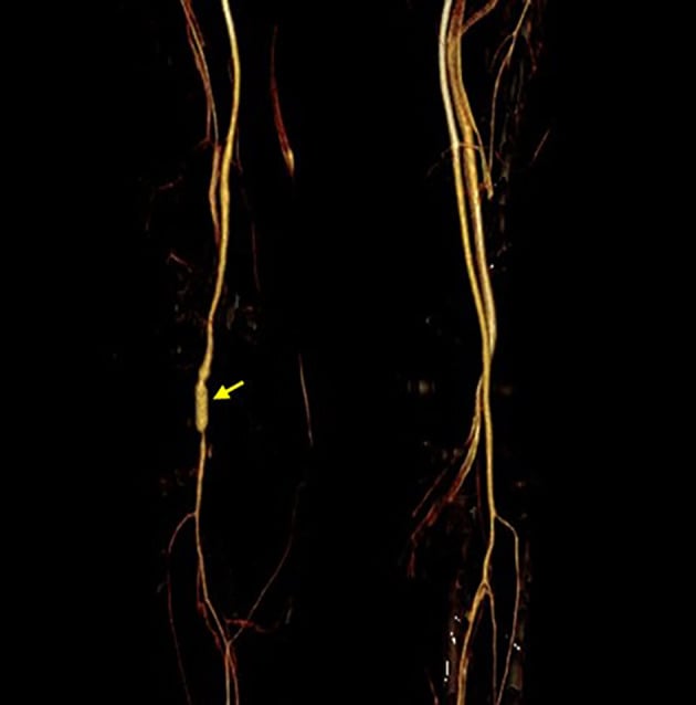 Lower-limb CT angiogram showing patent popliteal flow through a great saphenous vein interposition graft.