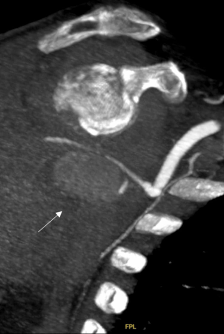 CT angiogram showing a pseudoaneurysm of the posterior circumflex branch of the axillary artery.