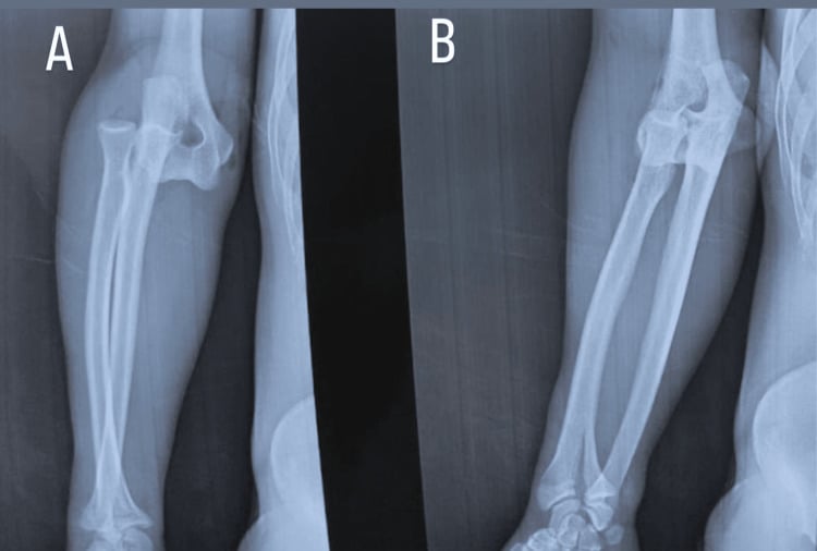 AP and lateral elbow radiographs showing a posterior elbow dislocation before reduction.