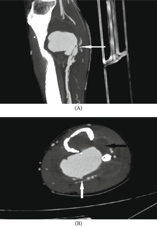 Sagittal and axial CT angiograms showing a partially thrombosed posterior tibial artery pseudoaneurysm.