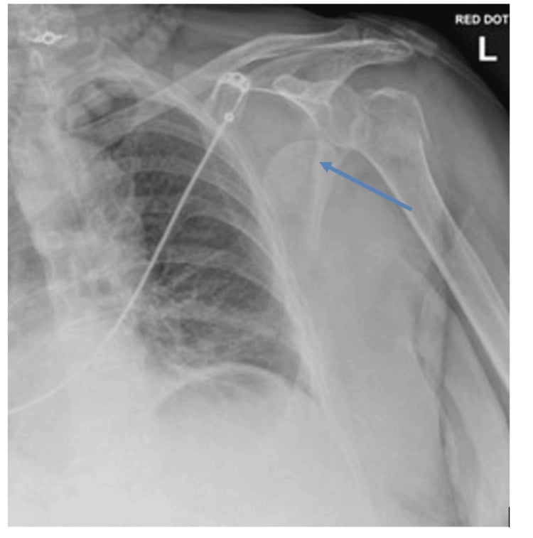 AP shoulder radiograph showing a comminuted proximal humerus fracture-dislocation with medial head displacement.