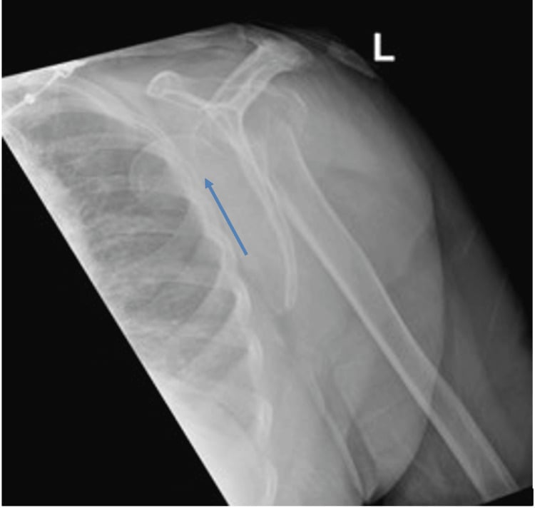 Lateral shoulder radiograph showing the humeral head displaced deep into the axilla.