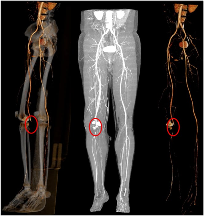 Multimodality imaging showing a high-energy tibial plateau fracture with a four-centimetre popliteal artery occlusion.