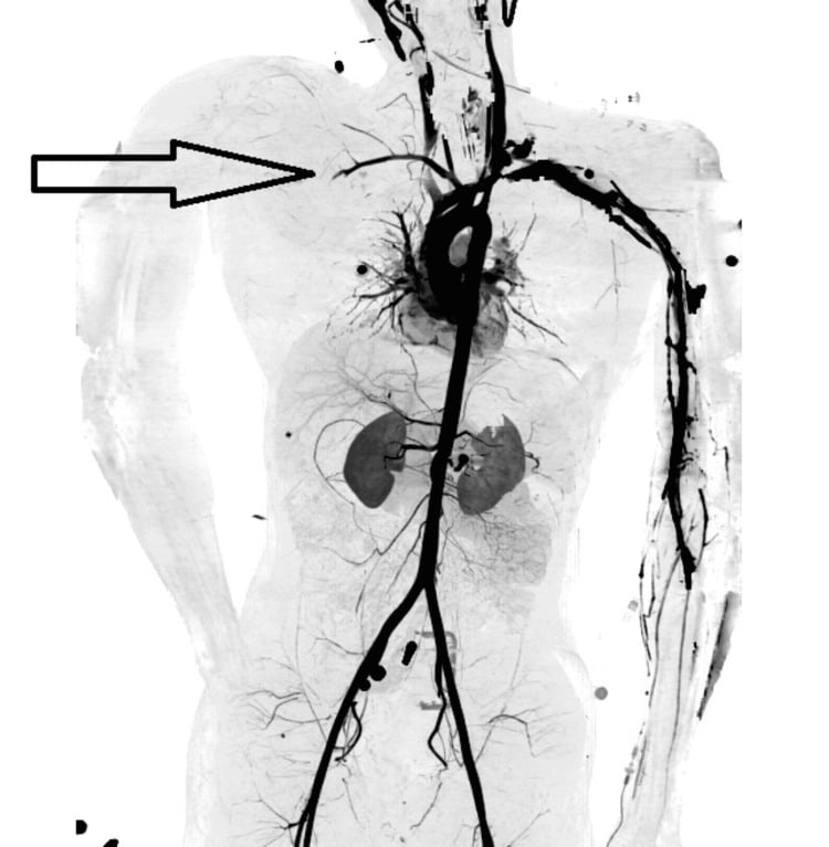 Three-dimensional CT angiogram showing absent arterial opacification in the injured right upper limb.