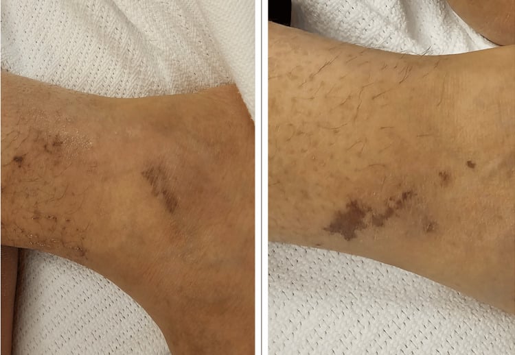 Dusky violaceous cutaneous lesions on the ankle in polyarteritis nodosa