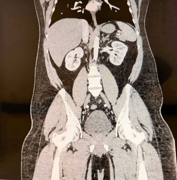 Contrast-enhanced CT angiography evaluating medium-vessel arterial branching in PAN