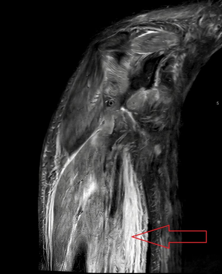 Coronal T2 STIR MRI of upper arm demonstrating vasculitic myositis and muscle edema