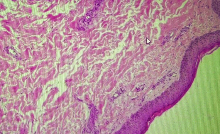 H&E histology section demonstrating leukocytoclastic vasculitis and fibrinoid necrosis