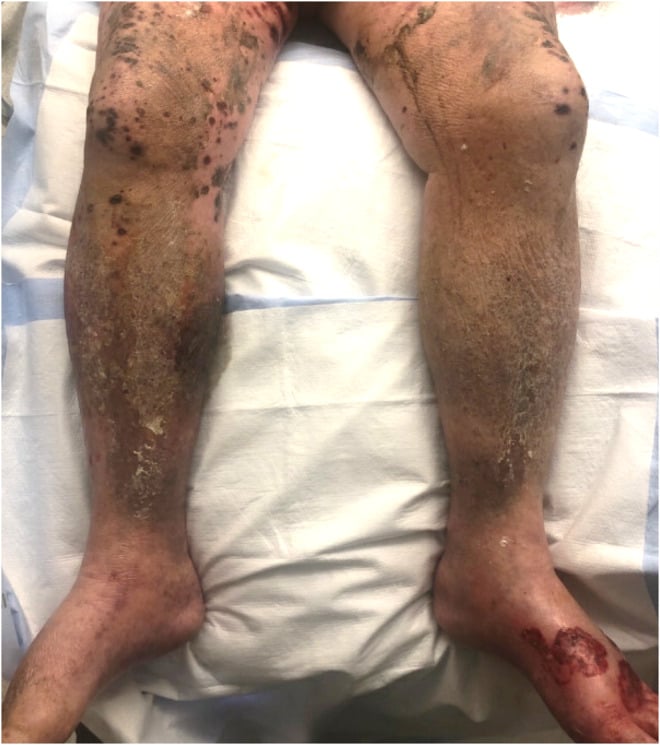 Clinical photograph demonstrating palpable purpura and cutaneous necrotic lesions in IgA vasculitis