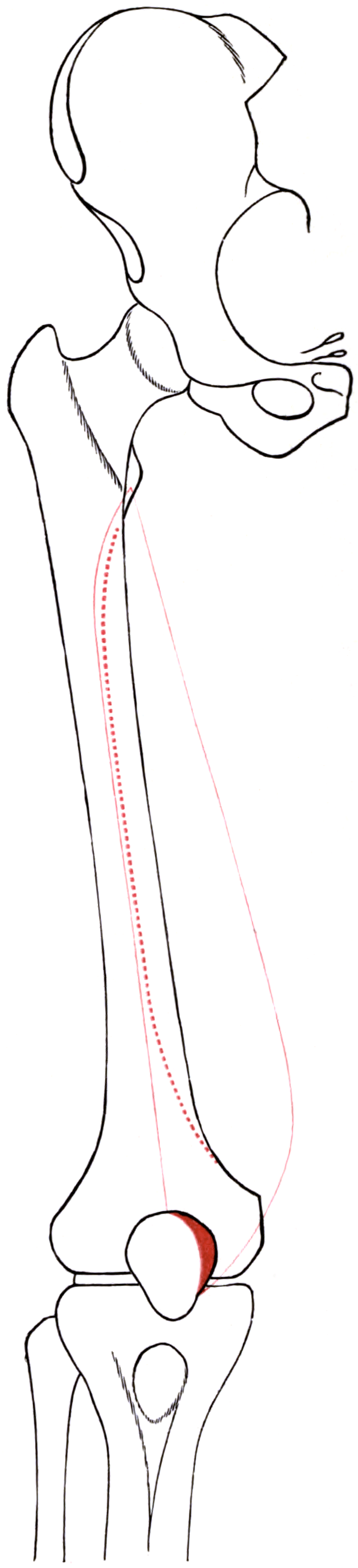 Public-domain outline of the right medial femur with the vastus medialis attachment course and distal area marked in red.