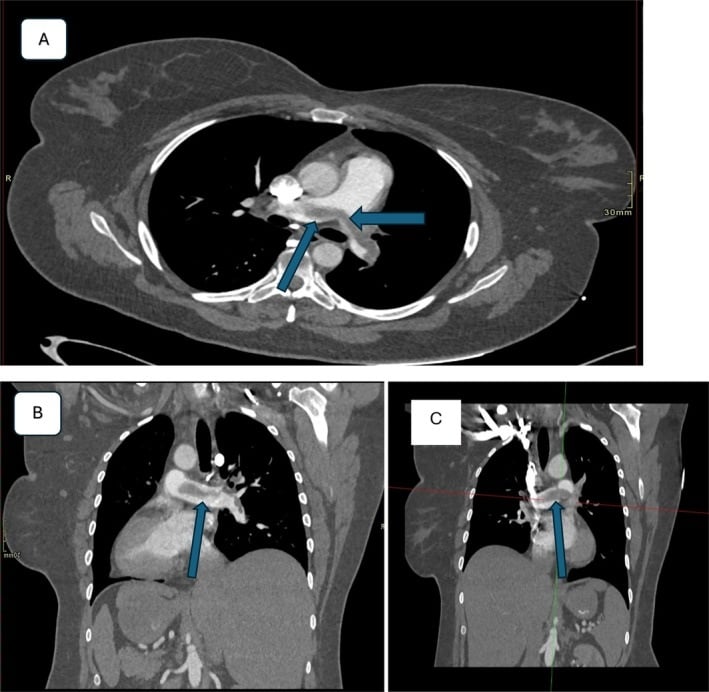 CT pulmonary angiography showing an acute saddle pulmonary embolus