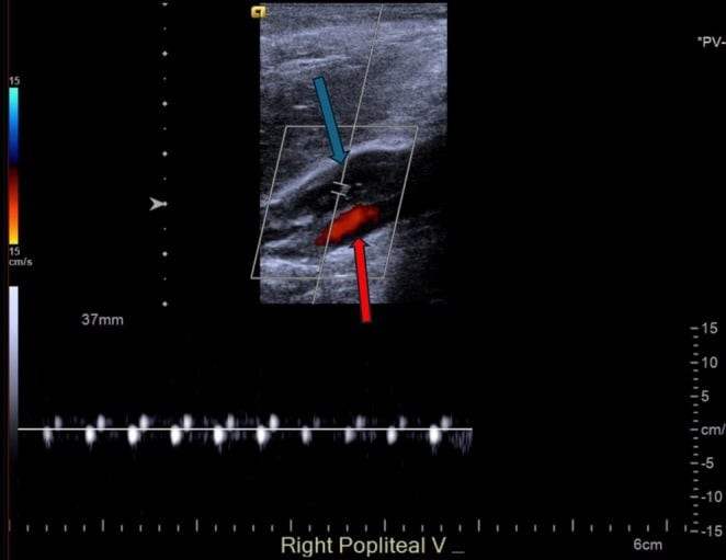 Duplex ultrasound showing acute right popliteal vein thrombosis