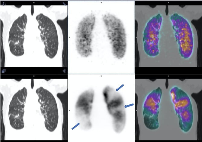 Ventilation perfusion PET-CT showing mismatched perfusion defects in pulmonary embolism
