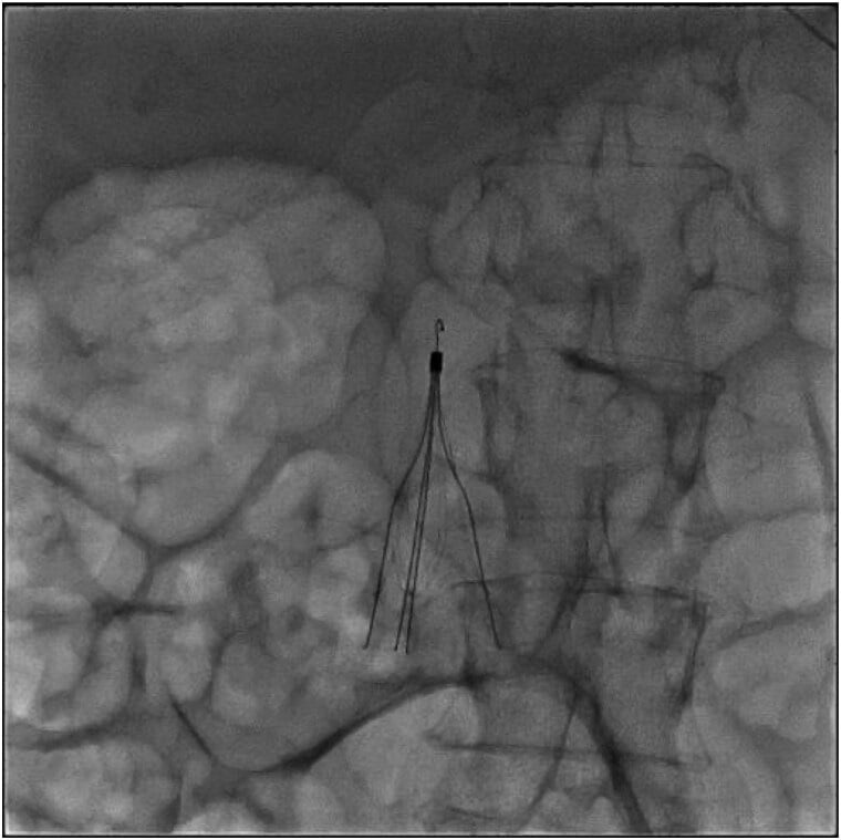 Fluoroscopy showing placement of an inferior vena cava filter
