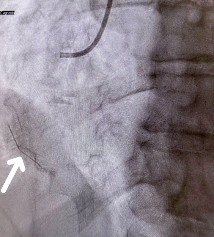 Abdominal radiograph showing a fractured inferior vena cava filter