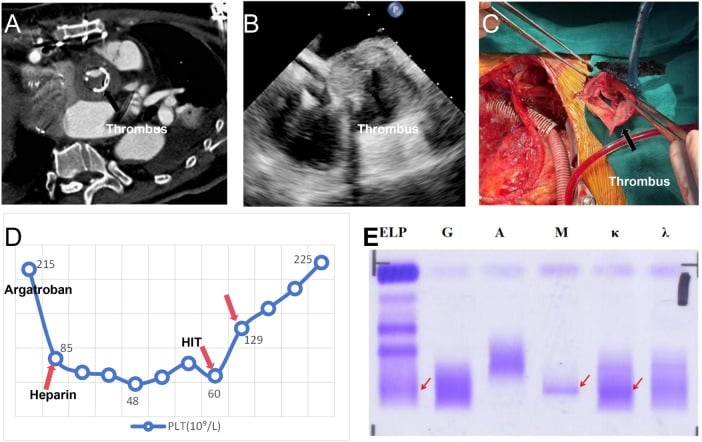 Imaging and operative findings of HIT-associated bioprosthetic aortic valve thrombosis
