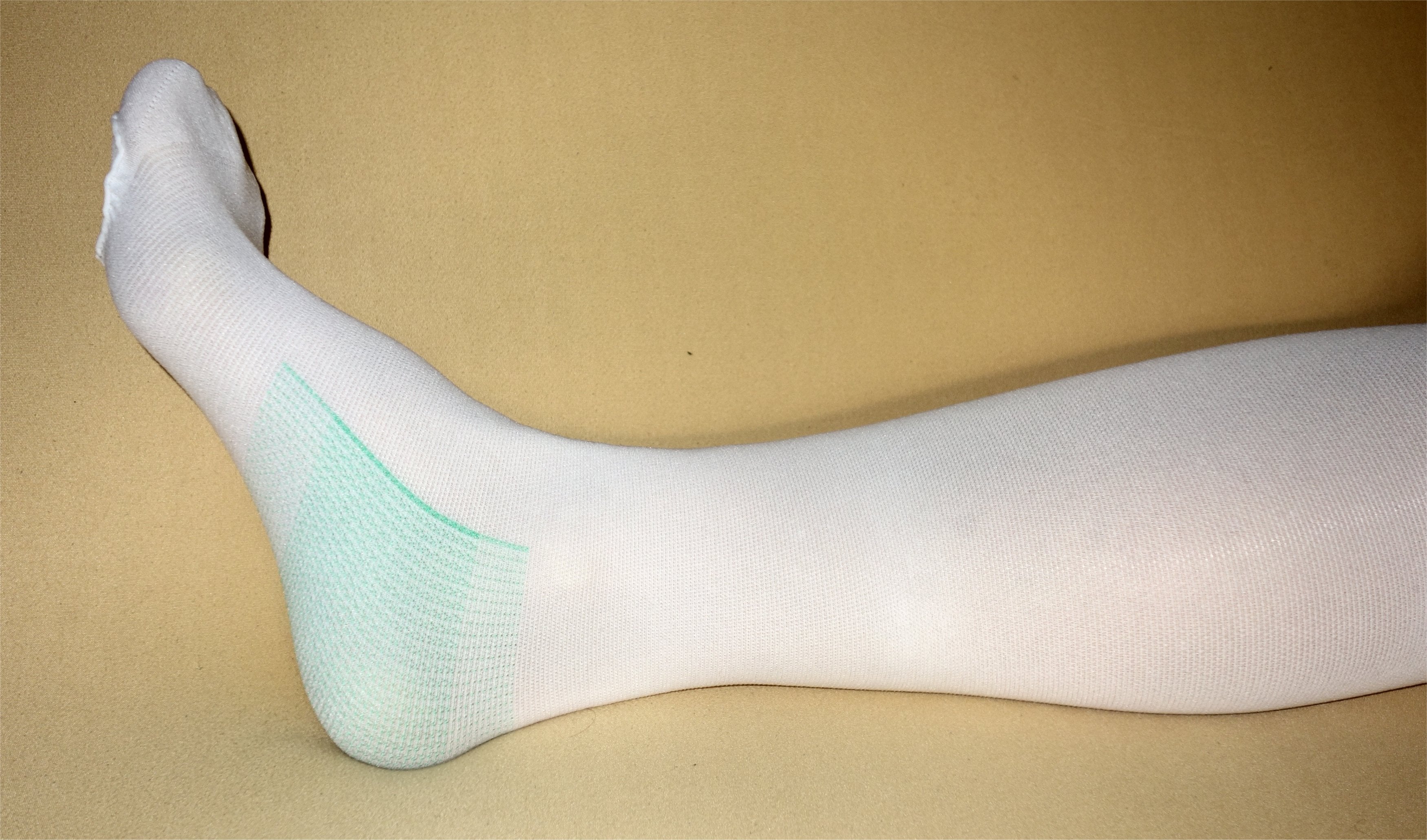 A graduated anti-embolism (compression) stocking on a leg.
