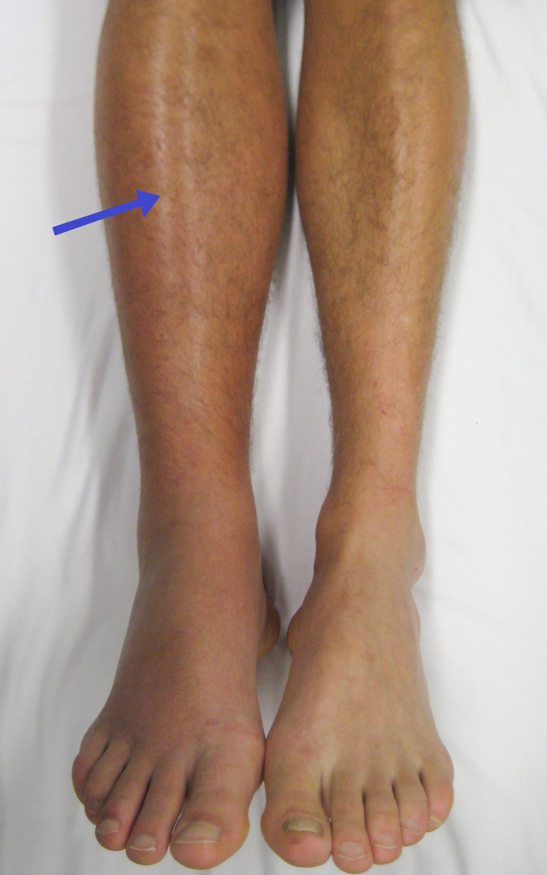 Clinical photograph of a deep vein thrombosis: unilateral right leg swelling and discolouration.