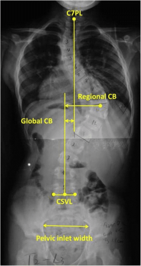 Frontal spine radiograph annotated with lines measuring coronal balance and pelvic inlet width.