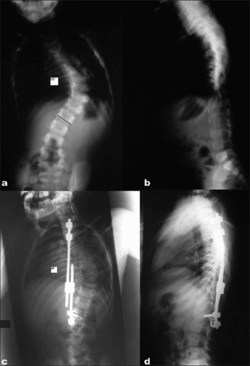Four radiographs: preoperative frontal and side views of a young child's spine and matching views two years later after growing-rod treatment.