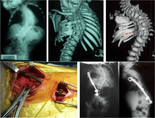 Radiograph of a child's chest and spine with fused and absent ribs, instrumented with a rib-based VEPTR device.