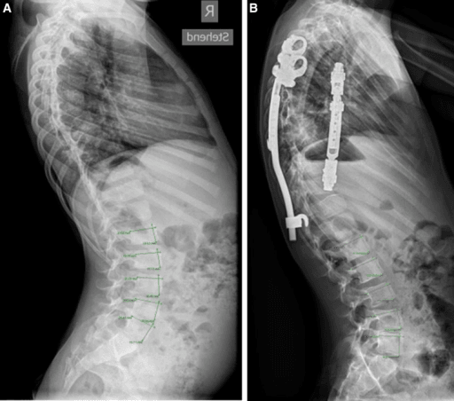 Radiograph of a young boy with VEPTR instrumentation over the thoracic spine and an uninstrumented lumbar spine.